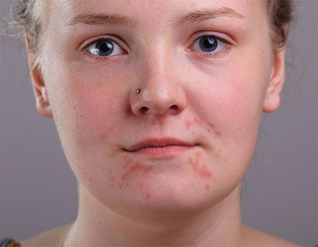 چگونه می توان از برس Spot Healing برای از بین بردن سریع برخی از جوش های حواس پرت کننده از صورت زن جوان استفاده کرد